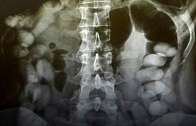 کشف ۷۷ بسته کوکائین
 ۵ میلیاردی از شکم مسافر در فرودگاه امام